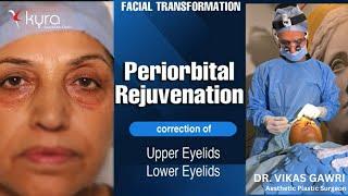 Blepharoplasty & Fat Grafting to Face | Eyelid Surgery in Ludhiana Punjab | Kyra Aesthetic Clinic