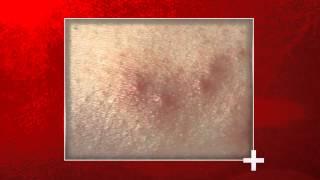 Signs of Bed Bug Bites - Health Checks