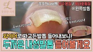 한쪽이 더 두꺼워진 내성발톱! 와이어로 들어볼게요 ingrown toenail / ingrowing nail - Fresh Foot 풋풋한리쌤 성수점 / 평내호평점