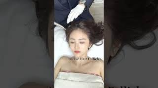 Fotona Hair Growth Laser | Fotona 生发治疗 - Define Aesthetic Medical Clinic