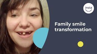 Covering Missing Teeth | Clip On Veneers | Instasmile Review