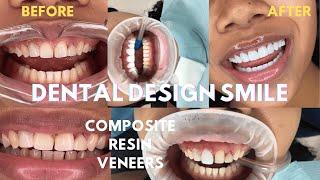 COMPOSITE RESIN VENEERS- MY HUGE TEETH TRANSFORMATION IN MIAMI! DENTAL DESIGN SMILE