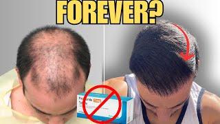 Are Hair Transplants Permanent Without Finasteride?