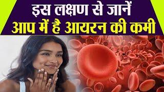 Iron Deficiency: आयरन की कमी के लक्षण और दूर करने का उपाय | Iron deficiency symptoms | Boldsky