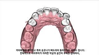 D1 Dental 디원치과 아미절라인 AMIsalign 투명교정 박*연 님 케이스리포트