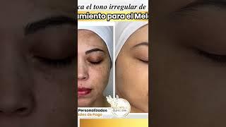 Trata las manchas de sol o pecas en el rostro ven a Paloma Clinic Spa #laser #pecas #laserpecas