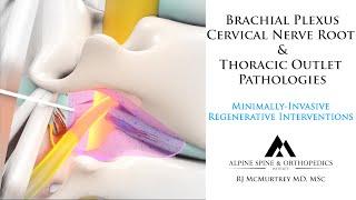 Thoracic Outlet & Brachial Plexus Nerve Syndromes: Minimally-Invasive Image-Guided Treatments