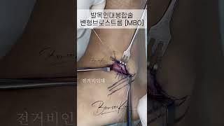 발목 인대봉합술 (MBO, 브로스트롬)