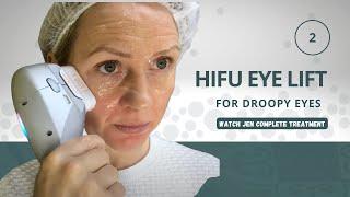 Unlocking Youthful Eyes: HIFU Eye Lift Revealed