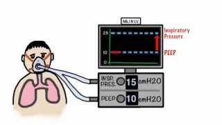 CPAP and Non-Invasive Ventilation in 5 minutes