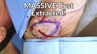 skibidi toilet rizzler gyatt and the BIGGEST cyst extraction!