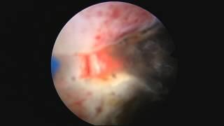 Bladder neck resection with Thulium laser, Dr. Farid Gadimaliyev, Customs Hospital, Baku, Azerbaijan
