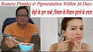 Remove Pimples & Pigmentation Within 20 days / चेहरे के दाग धब्बे ,पिम्पल के निशान हटाने के उपाय ||