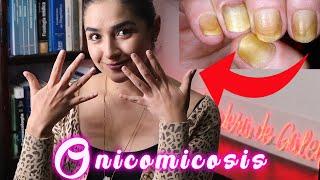 #Hongos en las uñas (#Onicomicosis) y en la piel (#Tiñas) / Todo lo que tienes que saber.