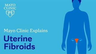 Mayo Clinic Explains Uterine Fibroids