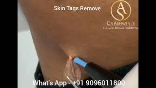 Skin Tags Remove| Dr.Ashwini Natural Brows academy and Beauty Clinic India| Pune