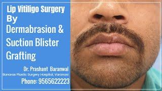 Lip Vitiligo Surgery in Varanasi - Dermabrasion & Suction Blister - Banaras Plastic Surgery Hospital