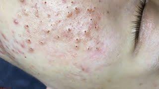 Loan Nguyen Acne Treatment 14u