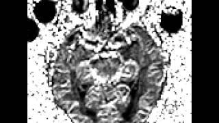 Degenerative Disease Alzheimers disease with functional MRI