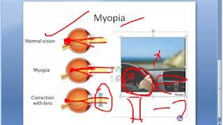 Ophthalmology 048 a Myopia Short Sightedness Eye Near Sight