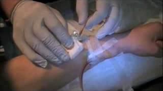 Dialysis Part II