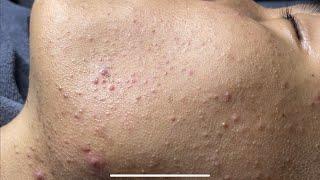 Blackheads & Whiteheads Removal New 2024 | Acne Treatment With  Bo Nguyễn Spa