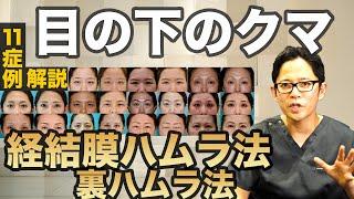 【11症例解説】9割以上の人が満足する目の下のクマ治療【経結膜ハムラ法（裏ハムラ法）】