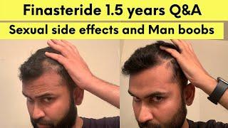 Finasteride 1.5 years Q&A | Sexual Side Effects | Gyno | Microdosing | Hair vigyan