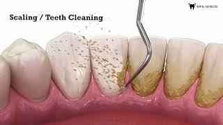 Scaling | Teeth Cleaning | Teeth Scaling | Scaling And Polishing | Dental Aesthetics