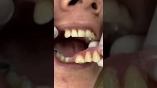 Flexible dental prosthesis without palate #mrdent #dentalclinic #smile #dentist #viral