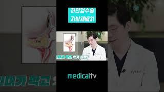하안검수술 지방재배치