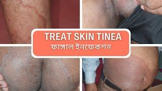 ফাঙ্গাল – How to Treat Skin Tinea Infection? Dr Hsaibur Rahman