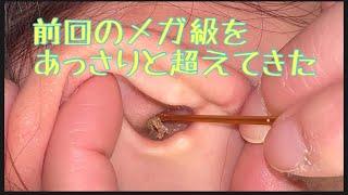 【耳かき】前回のメガ級を超えてきた　長女【耳掃除】