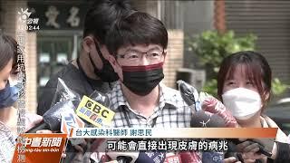 台灣出現首例猴痘 醫師籲避免發生不安全親密接觸｜20220625 公視中晝新聞