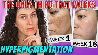 The ONLY Ingredients That Stop Hyperpigmentation (And Reverse It)