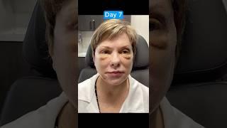 AMAZING FACELIFT JOURNEY TRANSFORMATION