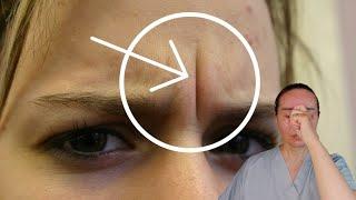 3 Powerful techniques to remove FROWN LINES