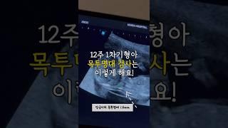 쌍둥이 1차 기형아검사(목투명대검사) #임신브이로그 #시험관 #쌍둥이임신