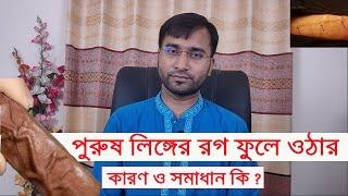 পেনাইল ভেরিকোজ ভেইন/ পুরুষাঙ্গের রগ ফুলে যাওয়ার কারণ ,লক্ষন ও সমাধান কি জেনে নিন