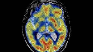 Degenerative Disease Mild Alzheimers disease