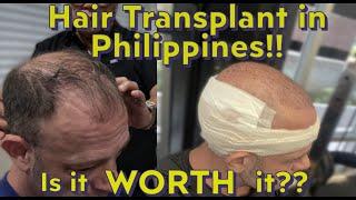 My Philippines Hair Transplant Result After 6 Months! (3000 Grafts)