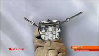 Wright Medical Infinity Total Ankle Implant