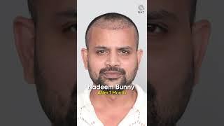 Youtuber Nadeem Bunny (Topa Bhai) 6 Months Hair Transplant Progress #shorts#hairtransplant
