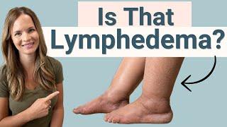 Lymphedema Signs and Symptoms