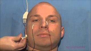 Motoric Neurography - Facial Nerve