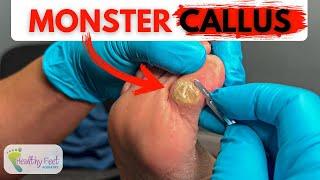  Extreme Foot Callus Removal! Biggest Case of the Year?! 