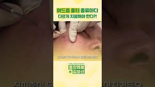 여드름 흉터, 종류마다 다르게 치료해야 한다?