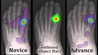 Eye tracking data and Bunion surgery