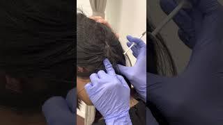 Treatment for migraine with Botox