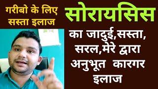 सोरायसिस का सफल आयुर्वेदिक इलाज|EXCELLENT TREATMENT OF PSORIASIS BY AYURVEDA|DR.PRASHANT SHUKLA|